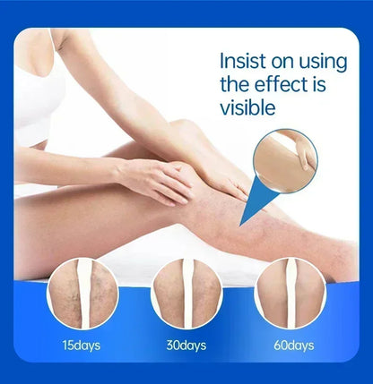 Effective Relief Varicose Vein Ointment Relieve Varicose Vein Vasculitis Spider Legs Pain Treatment Care Essential Cream
