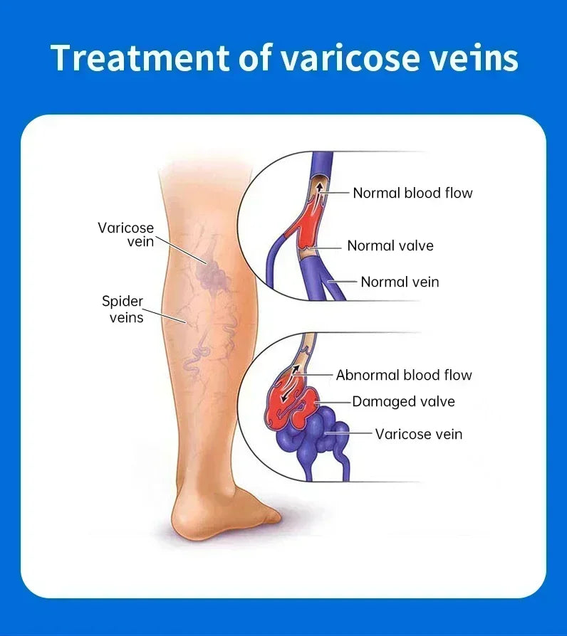 Effective Relief Varicose Vein Ointment Relieve Varicose Vein Vasculitis Spider Legs Pain Treatment Care Essential Cream