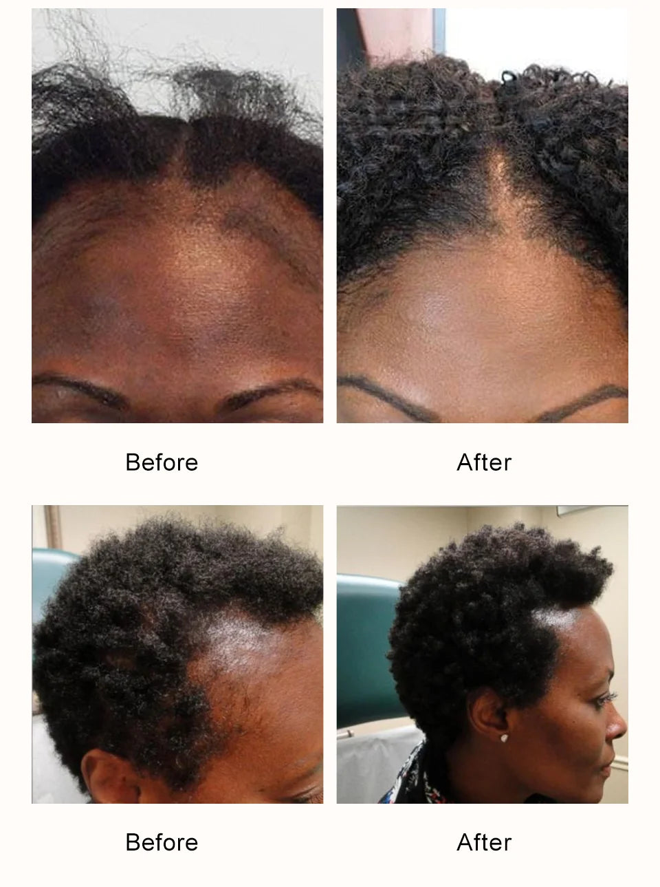 Sevich 100% Chebe Powder Effective Growthing Hair Improves Hair Density Nourishes Follicles Fast Regrowth Hair Product 100g