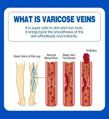 Effective Relief Varicose Vein Ointment Relieve Varicose Vein Vasculitis Spider Legs Pain Treatment Care Essential Cream