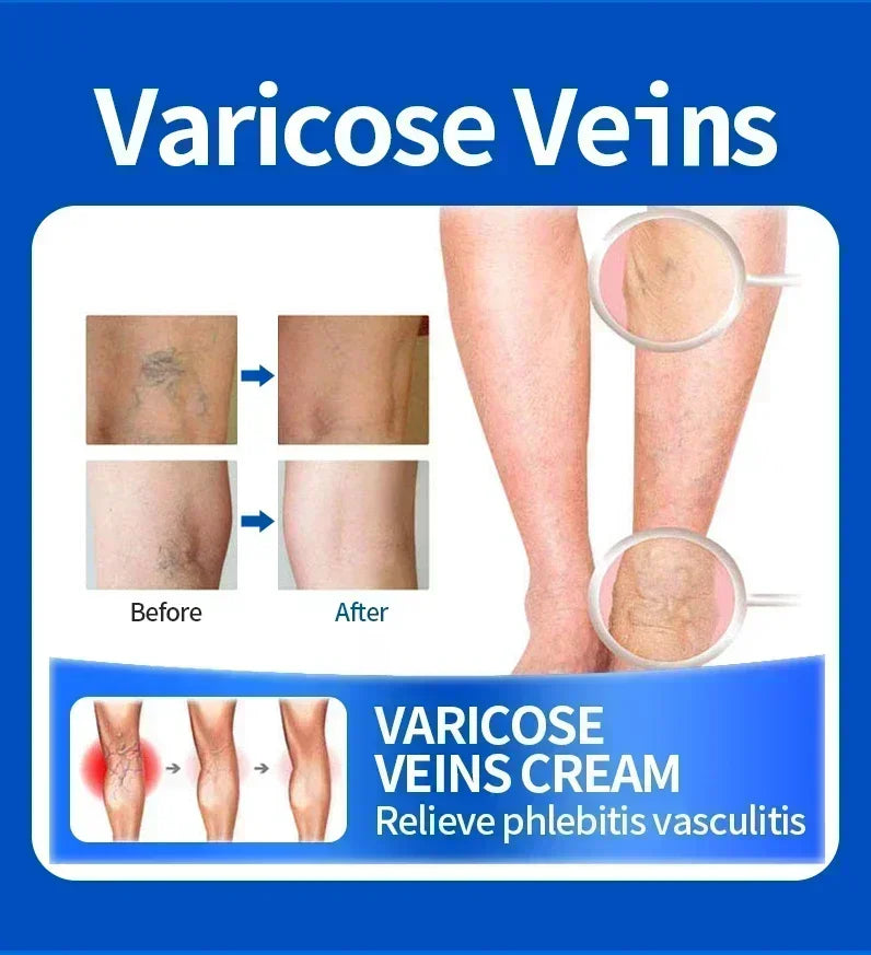 Effective Relief Varicose Vein Ointment Relieve Varicose Vein Vasculitis Spider Legs Pain Treatment Care Essential Cream