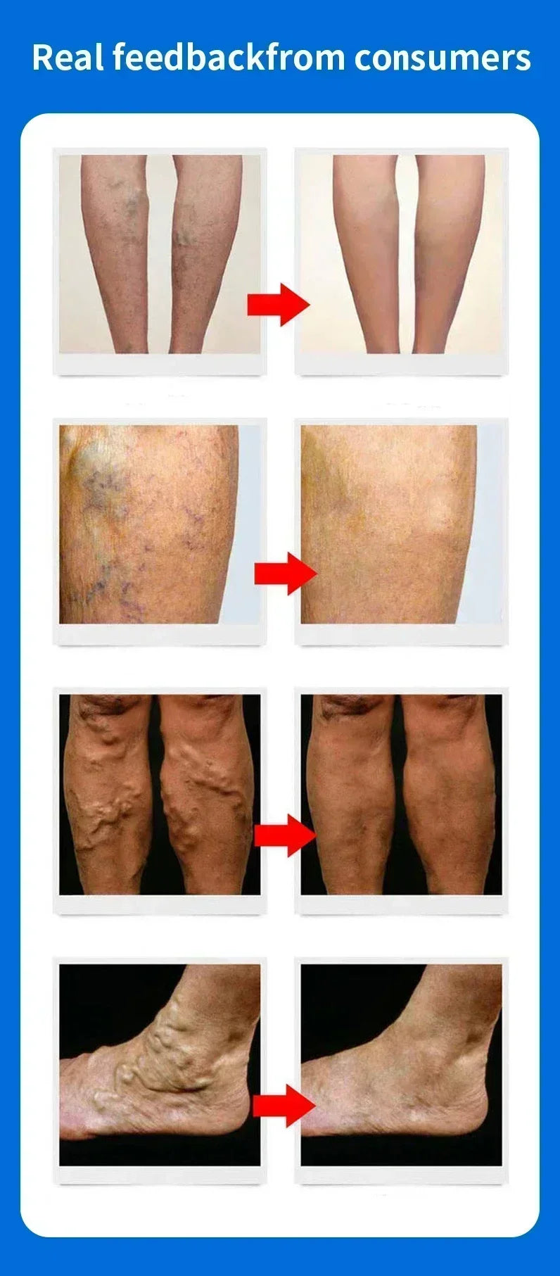 Effective Relief Varicose Vein Ointment Relieve Varicose Vein Vasculitis Spider Legs Pain Treatment Care Essential Cream