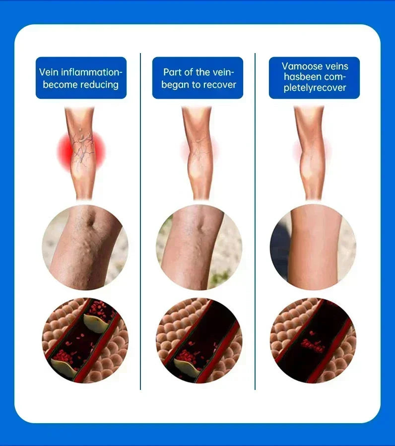 Effective Relief Varicose Vein Ointment Relieve Varicose Vein Vasculitis Spider Legs Pain Treatment Care Essential Cream