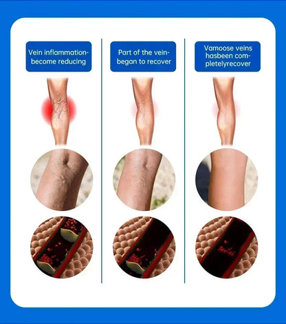 Effective Relief Varicose Vein Ointment Relieve Varicose Vein Vasculitis Spider Legs Pain Treatment Care Essential Cream