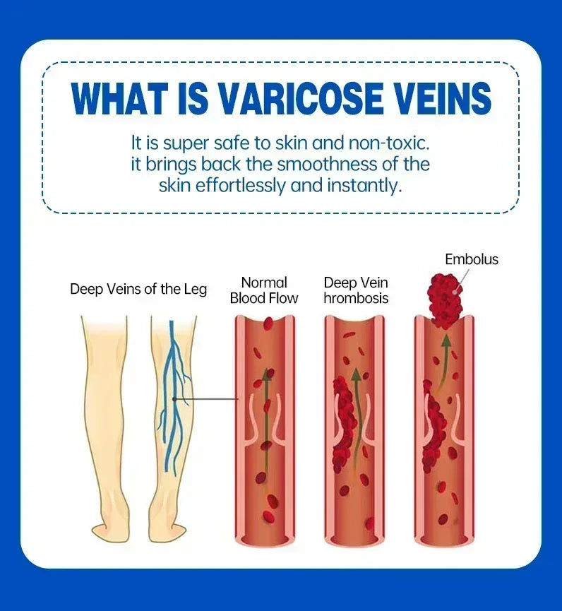 Effective Relief Varicose Vein Ointment Relieve Varicose Vein Vasculitis Spider Legs Pain Treatment Care Essential Cream